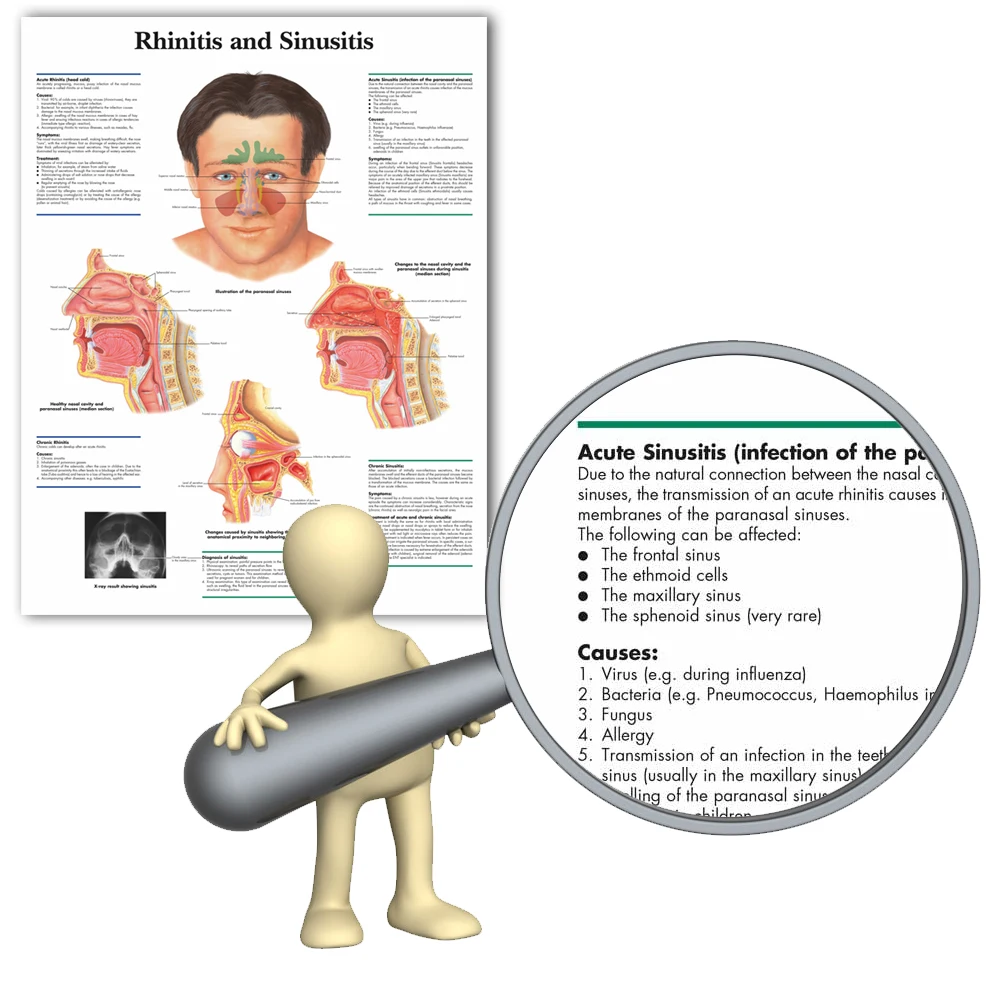 WANGART Medical Science Anatomy Rhinitis  Sinusitis Chart  Posters Canvas Print Wall Pictures for Medical Education Home Decor