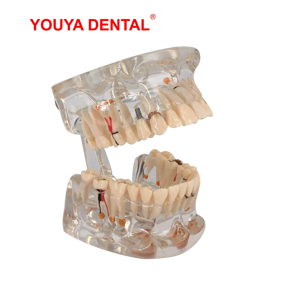 1pcs Transparent Dental Model Teeth Restoration Bridge Tooth Implant Model For Studying Teaching Medical Science  Detal Products