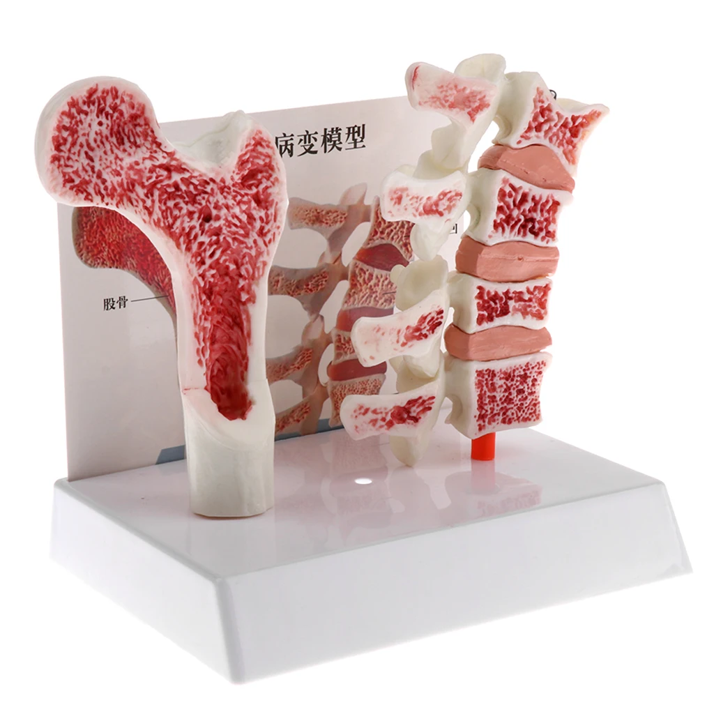 1:1 Anatomical Human Lumbar Vertebra Thighbone Model, Osteoporosis Skeleton Model, for Science Classroom Study Display