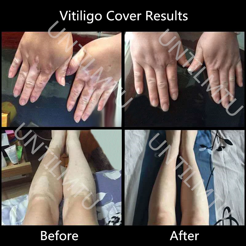 Vitiligo Corrector Corrector Pluma Impermeable Larga Duración Cara de la Mano Cuerpo Depigmentado Piel de Piebald Maquillaje Líquido Instantáneo 2