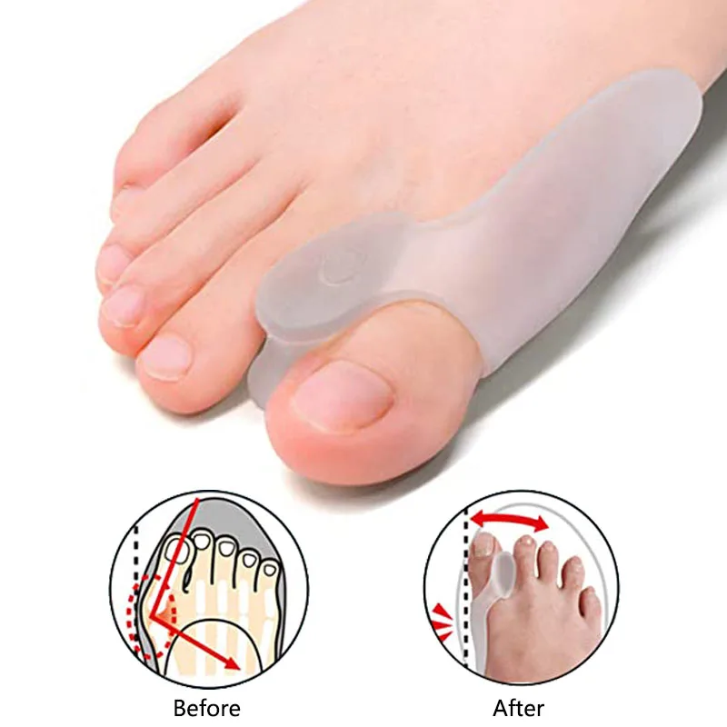 Coussin correcteur d'hallux Valgus en Silicone, séparateur d'orteils et de doigts, soulage la douleur des oignons, redresseur du gros orteil, outil de soins des pieds, 2 pièces