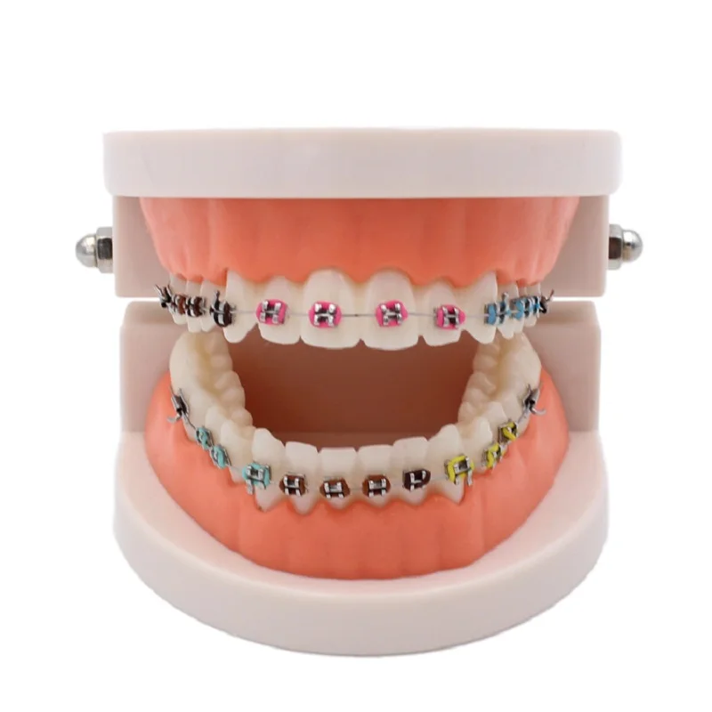 Dental Orthodontic Treatment Model With Ortho Metal Ceramic Bracket Arch Wire Buccal Tube Ligature Ties Dentist Tools Lab