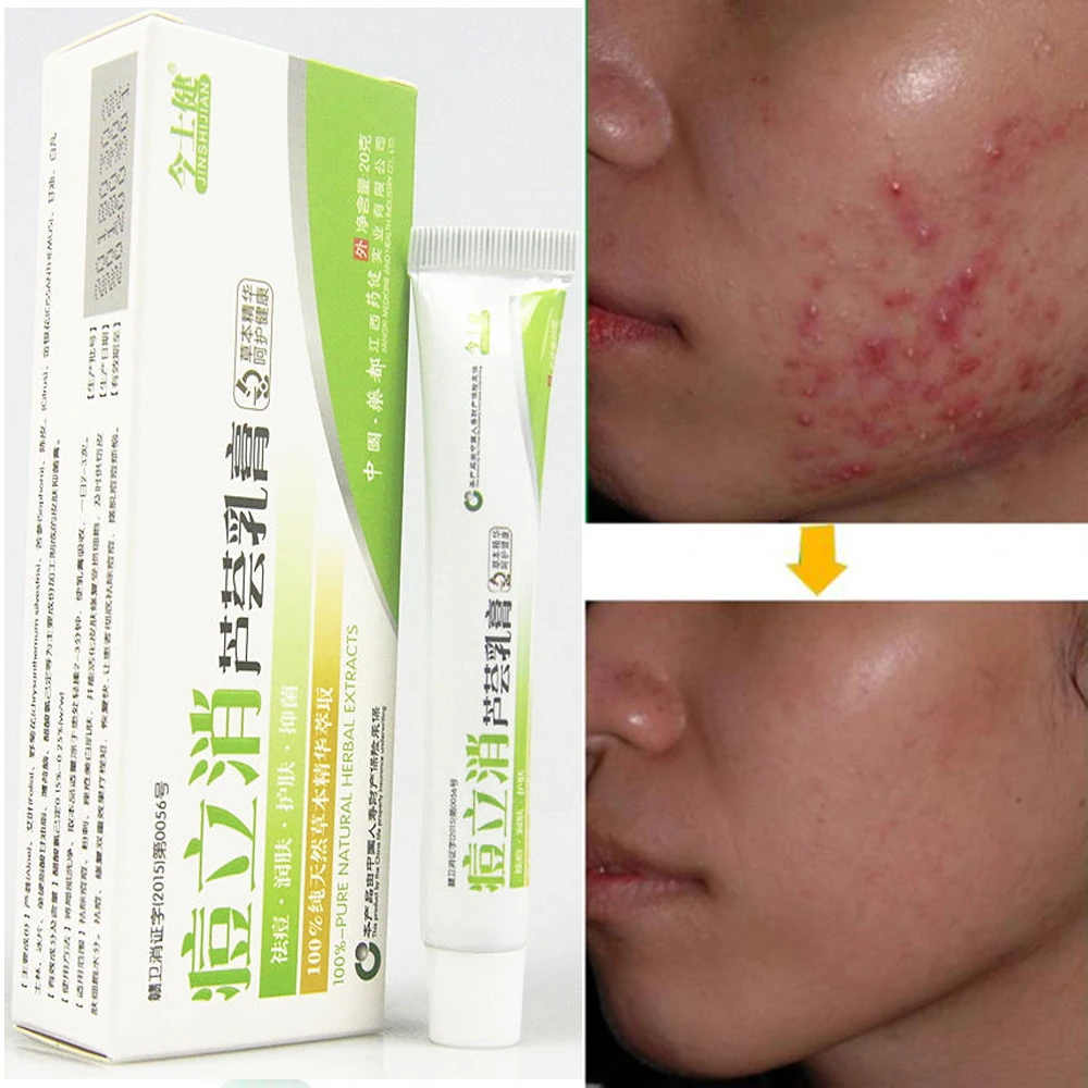 

Skin Care Tool Beauty products Facial skin repair Acne cream Oil control Acne removal Facial skin care Acne cream