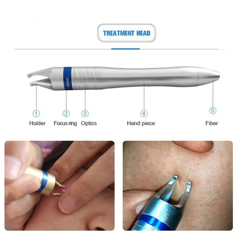 Macchina per la rimozione delle vene del ragno pigmento Telangiectasia rimozione dell'attrezzatura effetto Super buono spedizione gratuita