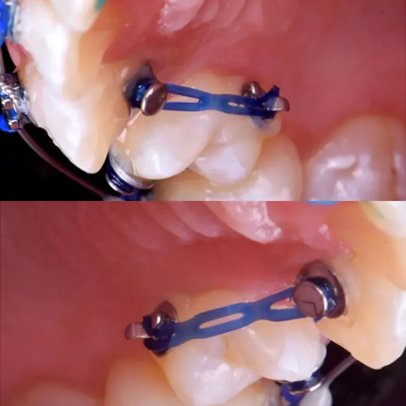 Crochets de Traction en métal Composite, 10 pièces, pour dentisterie, matériaux orthodontiques