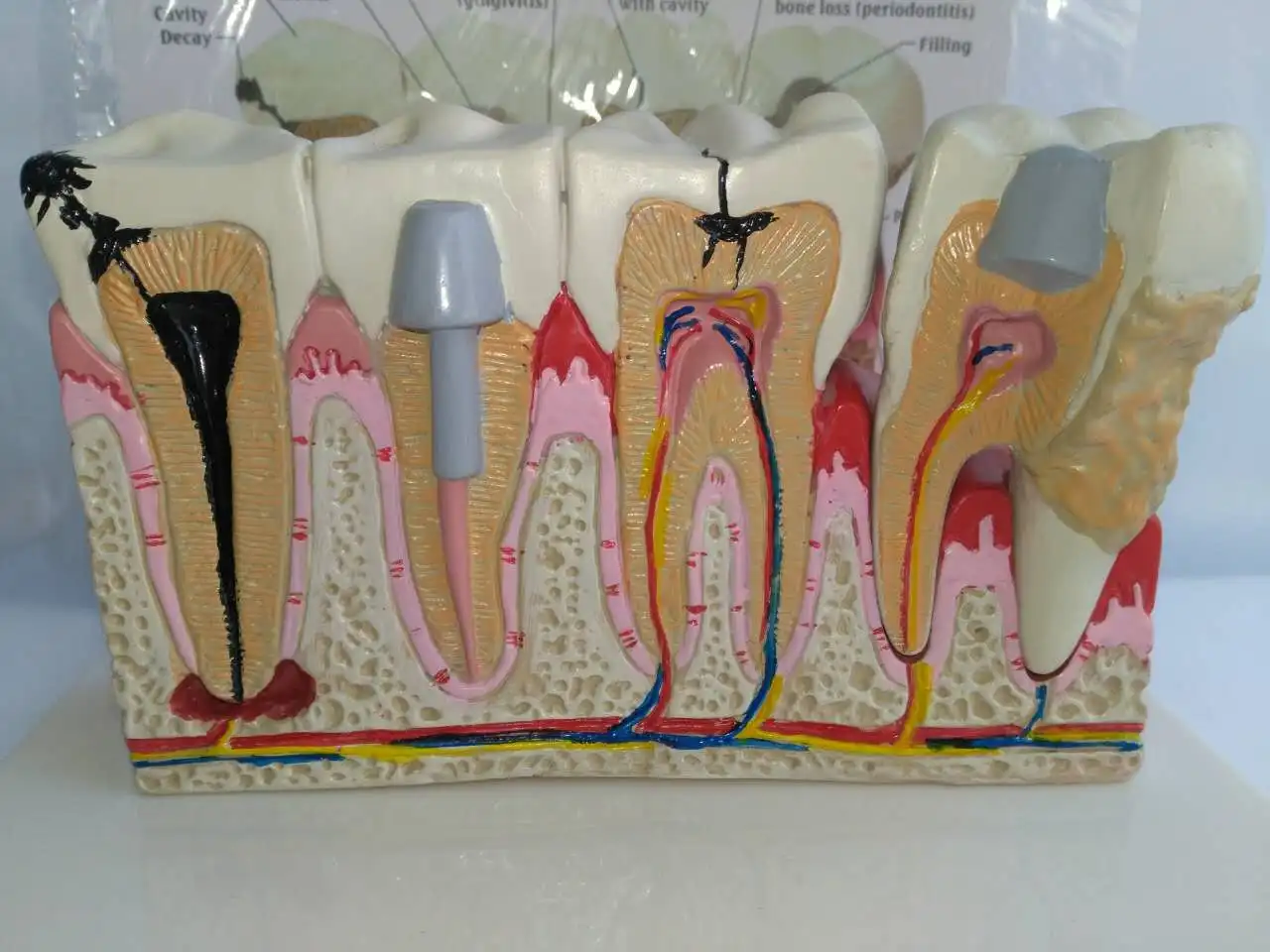 Human Tooth Common Pathologies Anatomy Model   Dental Model Medicine Teaching Instrument