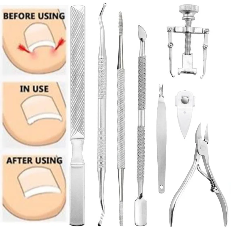 

Professional Pedicure Tools Ingrown Toenail Tools Kit Nail Care Ingrown Toenail Removal Correction Clippers Foot Care 5/6/7/8pcs