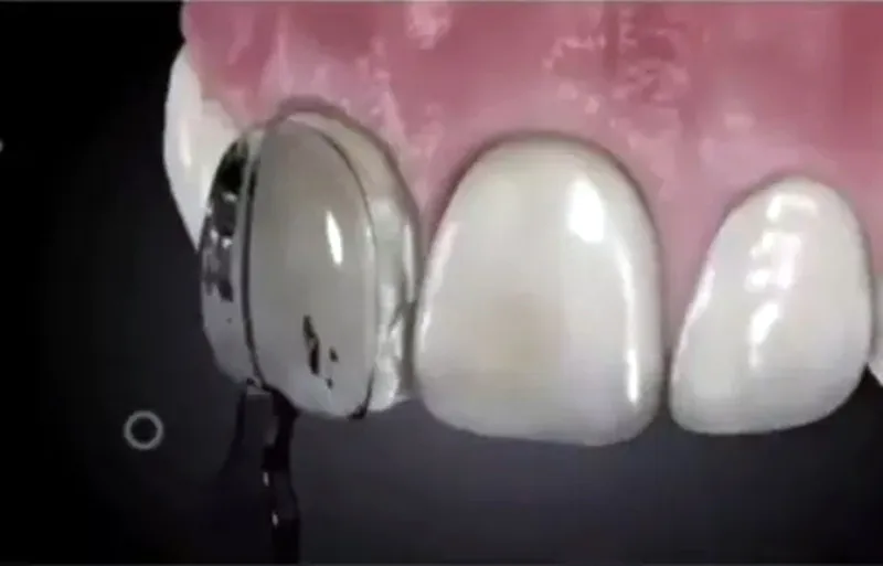 30Pcs Dental Mould Composite Resin Light Cure Anterior Front Teeth Fast Quick