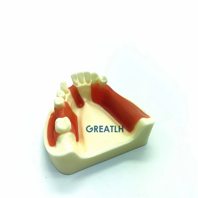 Dental Lower Jaw Implant Practice model Gingiva with missing teeth dentist educational dental school teeth practise model