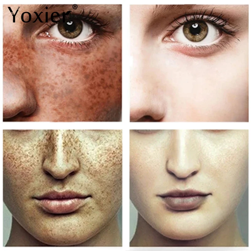 Yoxier 10Pcs Dark Spot Corrector Cream Moisturizing Remove Spots Sunburn Freckles Arbutin Anti-Aging Nourish Whitening Skin Care