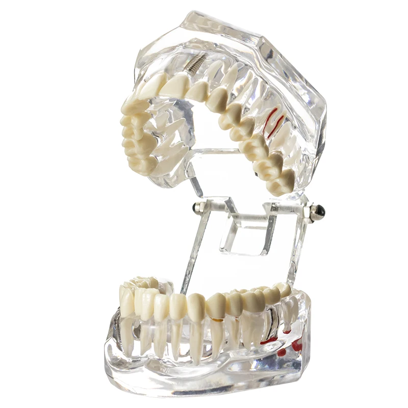 Dental Model Teeth Implant Restoration Bridge Teaching Study Medical Science Disease Dentist Dentistry Products Dental Gift