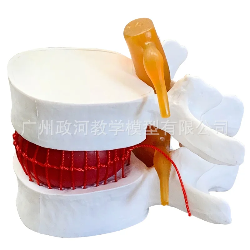 

1.5 Times Life Size Human Lumbar Disc Herniation Demonstration Model Lumbar Model Spine Model Biology Medical Skeleton Toy