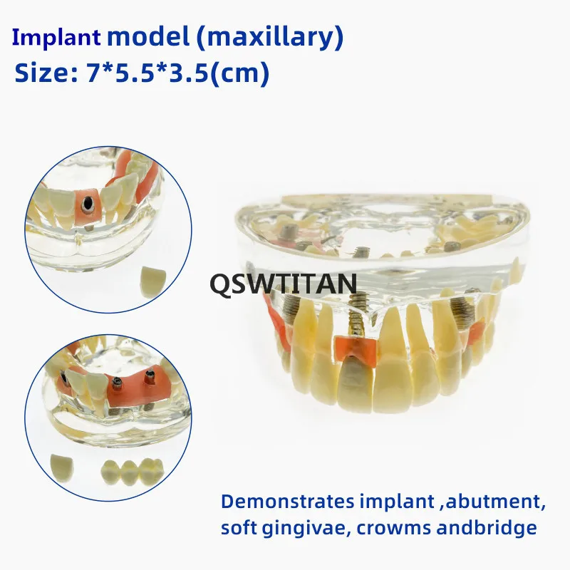 Dental  Implant Model With Bridge & Caries  Dental Study Teach Teeth Model  Dental Teaching Resources