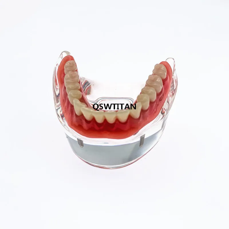 Dental Overdenture Model zębów zdejmowane wnętrze żuchwy z 2 implantami do nauczania zębów