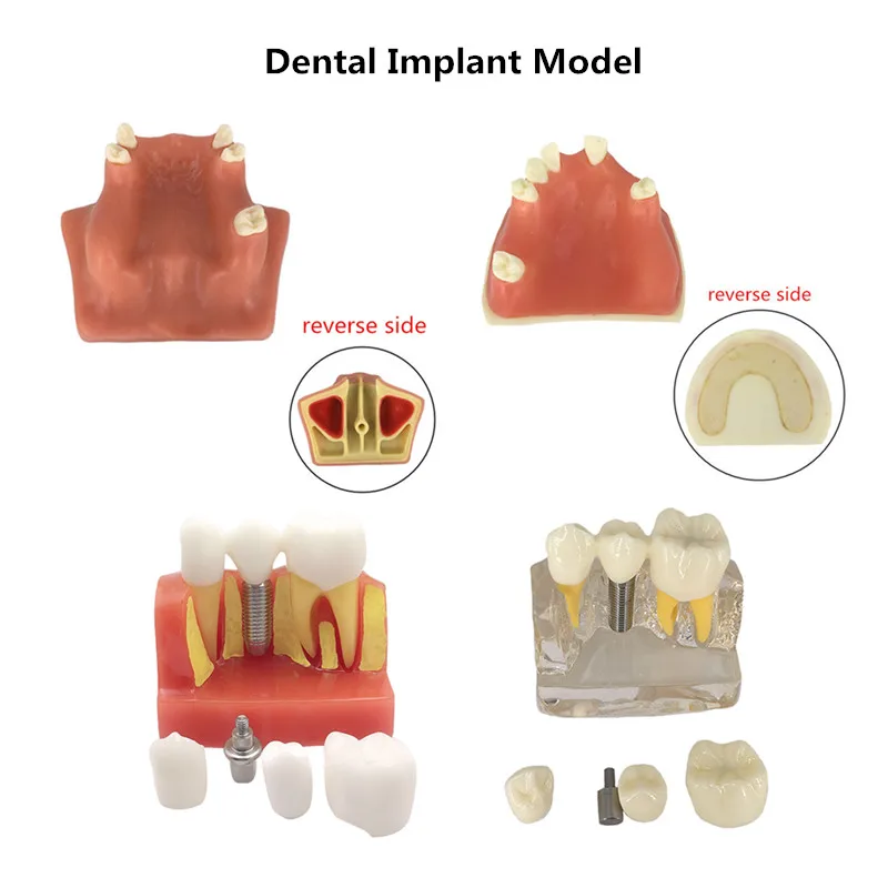 Modelo de enseñanza de dientes, Material de Odontología de resina, implante de ortodoncia extraíble, varios modelos dentales, 2022