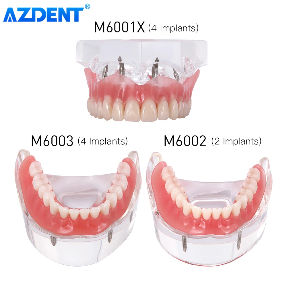 AZDENT Dental Implant Teeth Model Removable Interior Mandibular Demo Overdenture With Implants Upper Lower Tooth Teaching Study