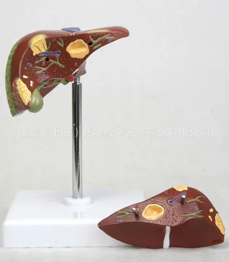 Human Hepatitis B Fatty Liver Cirrhosis Medical Model Digestive Medicine Hepatobiliary Health Care