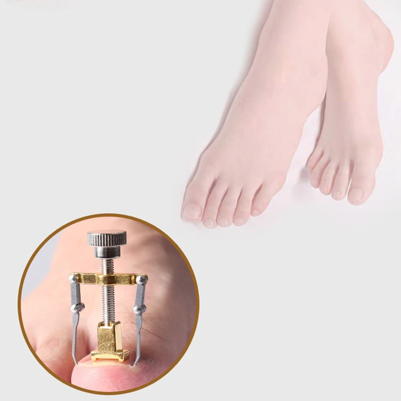 Treatment Ingrown Toenail Paronychia Correction Tools Professional Pedicure Nail Care Tools Orthotic Toe Nail Supplies