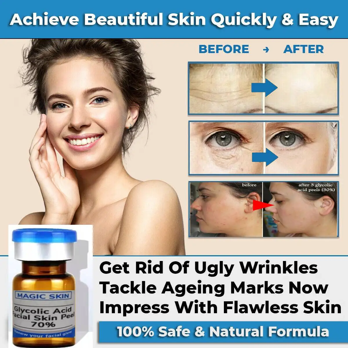 Glycolic Acid  Facial Skin Peel 70% Chemical Chemical Peel for Pigmentation Acne SCARS WRINKLES ANTI-AGING PORES