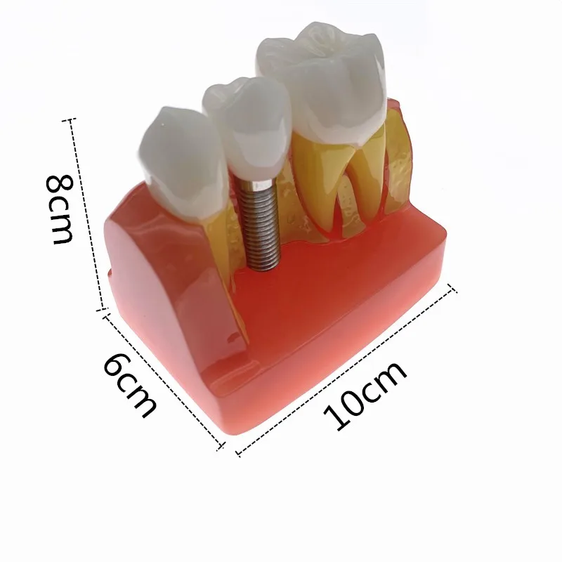 

Dental Teach Implant Analysis Crown Bridge Removable Model Dental Demonstration Teeth Model