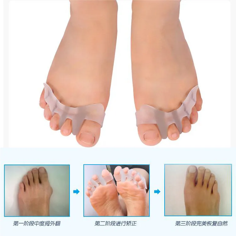 1Pair  Silicone Thumb Separation Orthosis Care Treatment Hallux Valgus  Toe Separator Divider Thumb Bunion Correction Protector