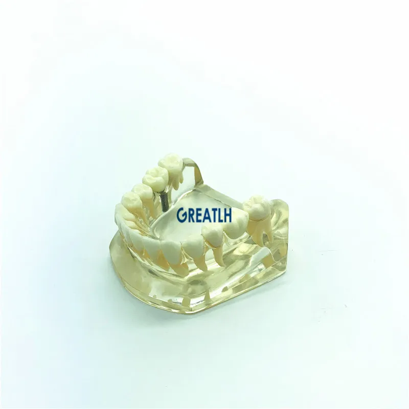 Dental implant fixtures Bridge Model Lower Jaw teeth Implant Typodont dentistry teaching model