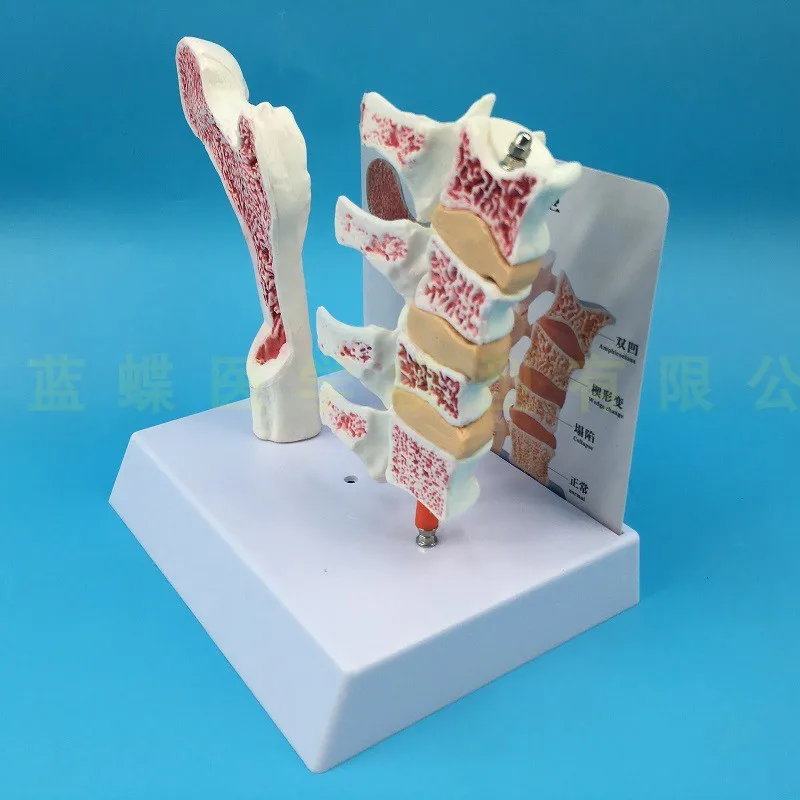 

4D Human femur osteoporosis anatomical model leg bone surface spine section specimens diseased lumbar spine model