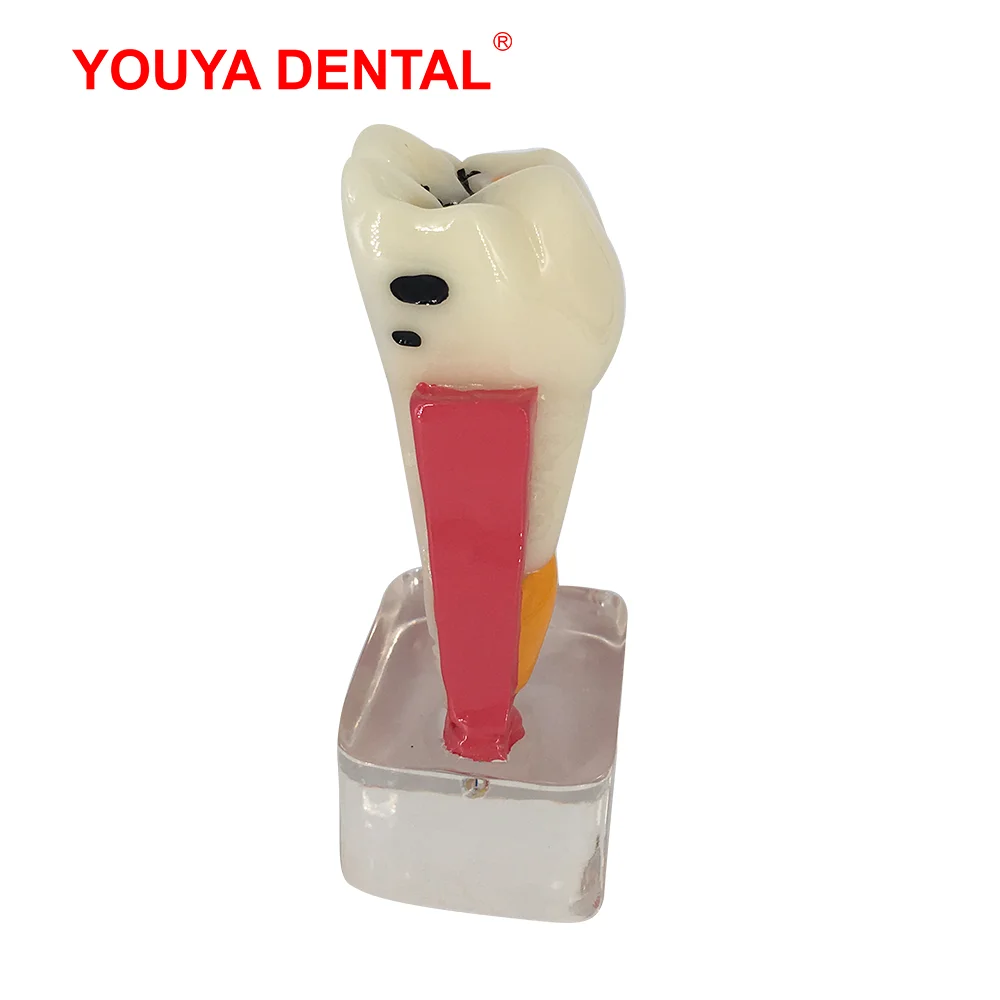 Dental Model Resin 4times Transparent Molar Anatomy Teeth Modeling With Nerves Medical Science Oral Dentist   Dentistry Products