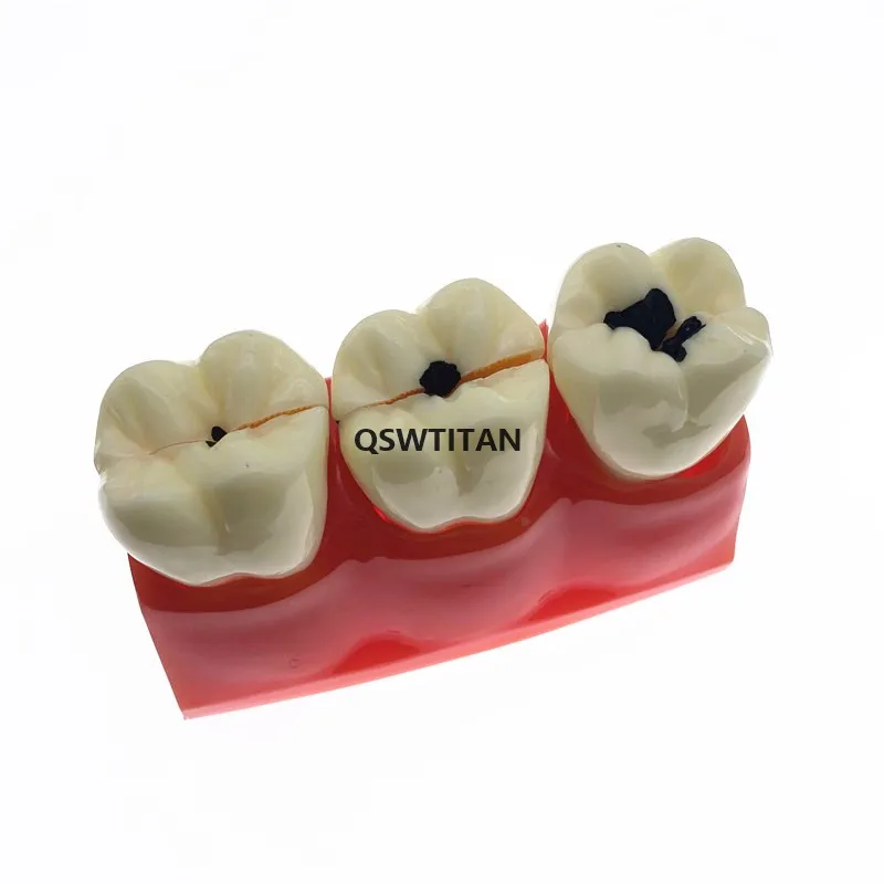 4Times Caries Models Caries teeth model for showing the progress of caries,fistula Teaching Research Model