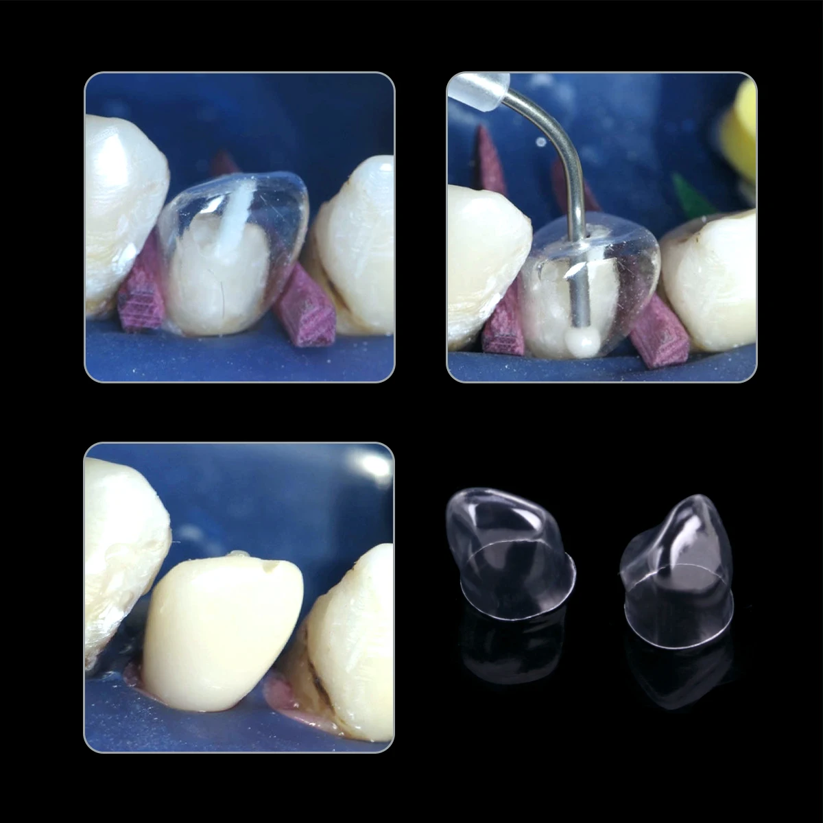64 Stück Erwachsene Dental Anterior Transparente Kronen Zahnarztwerkzeuge 1.910 Anterior Transparente Kronen 64 Stück – Detail 6