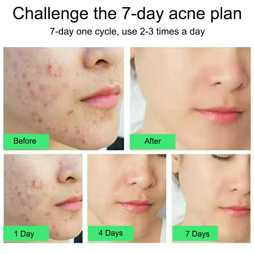 Acne Treatment Face Cream Scar Blackhead Remover Repair Gel Oil Control Shrink Pores Whitening Skin Care Korean Cosmetics