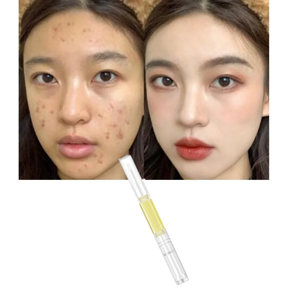 Whitening Freckle Vitamin K Cream Liquid Remove Melasma Acne Spot Pigment Melanin Dark Spots Moisturizing Skin Care Pen