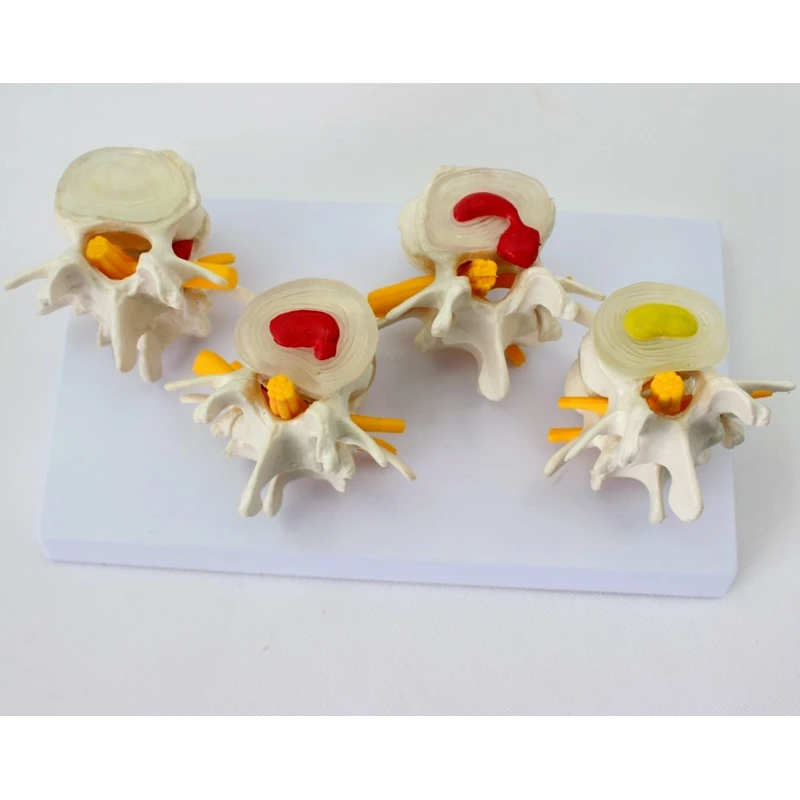 4 pcs different level one set Medical human Lumbar disc hernia Demo Model  demonstration model spine model