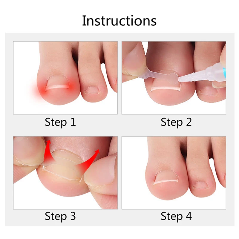 10Pcs เท้าเล็บเท้าเครื่องมือแก้ไข Elastic Patch สติกเกอร์ยืดคลิปรั้ง Pedicure เครื่องมือ