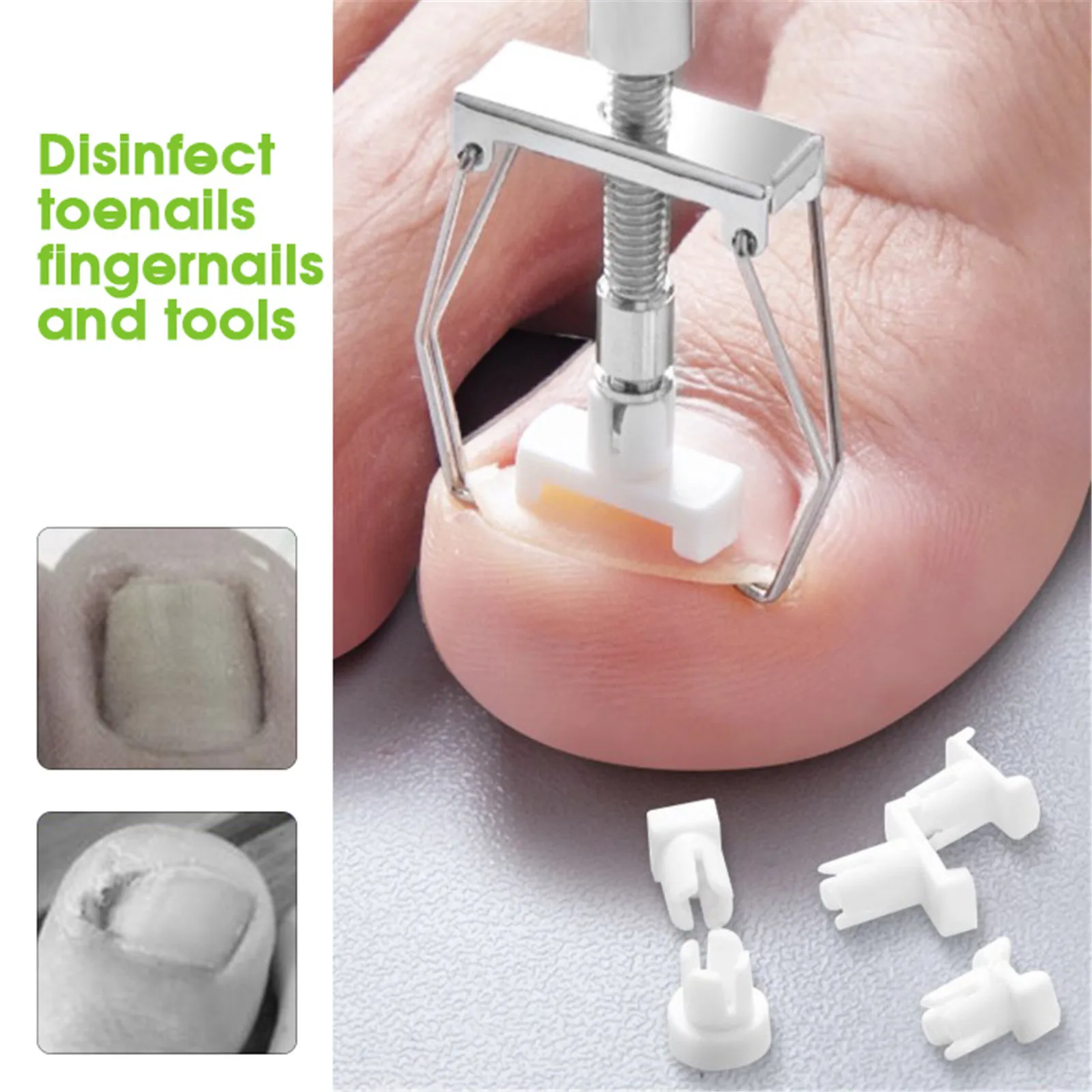 Ingrown Nail Recover Correction Pedicure Toenail Fixer Ingrown Foot Nails Care Tool Orthotic Toe Nail Corrector Pedicure Tool - Image 4