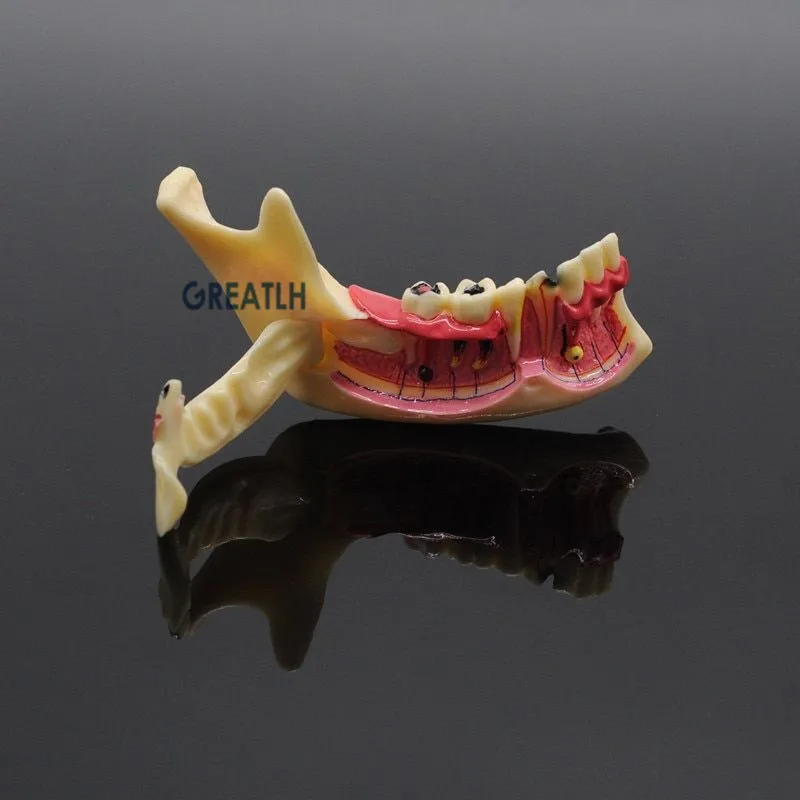 Dental leczenie endodontyczne Model anatomia dziąseł badanie stomatologiczne naucz Model zębów