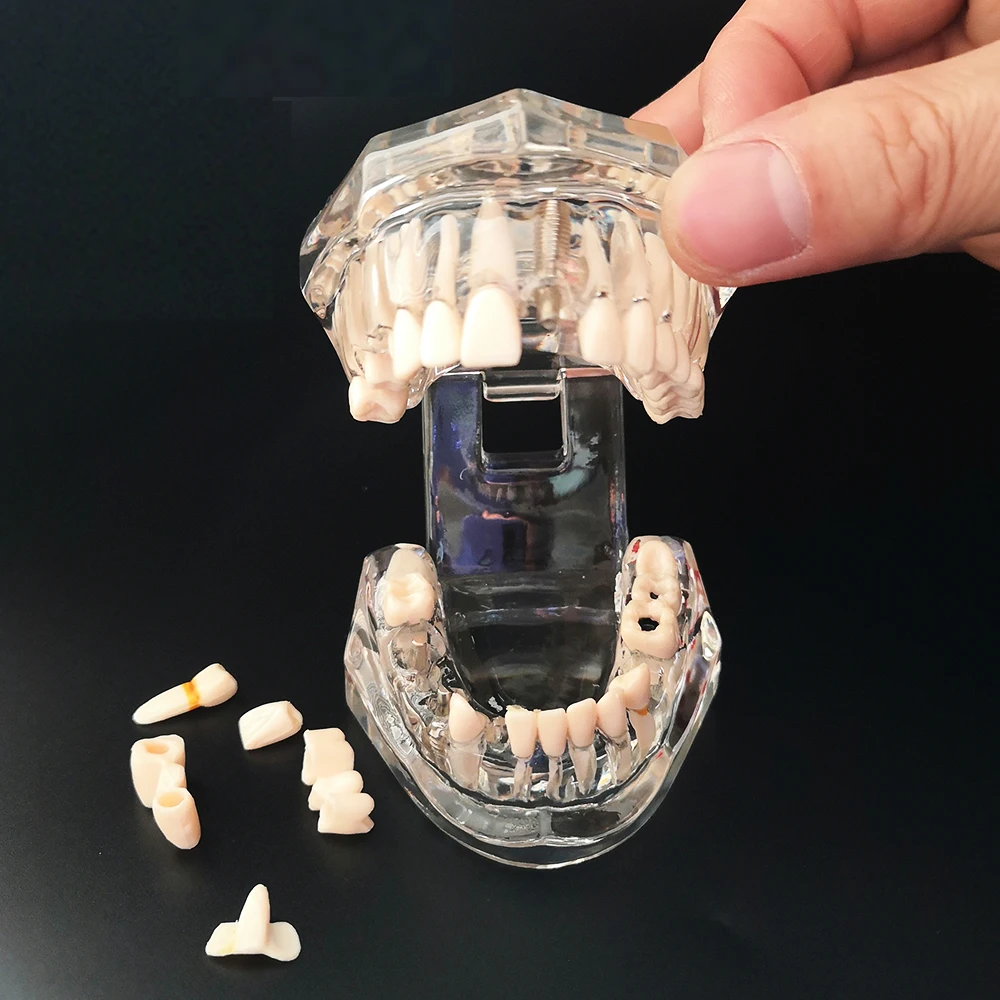 Neues Dentalmodell für Zahnimplantate, Restaurationsbrücken, Lehrmaterial für Medizinische Wissenschaft, Krankheiten, Zahnärzte und Zahnmedizinprodukte – Detail 2