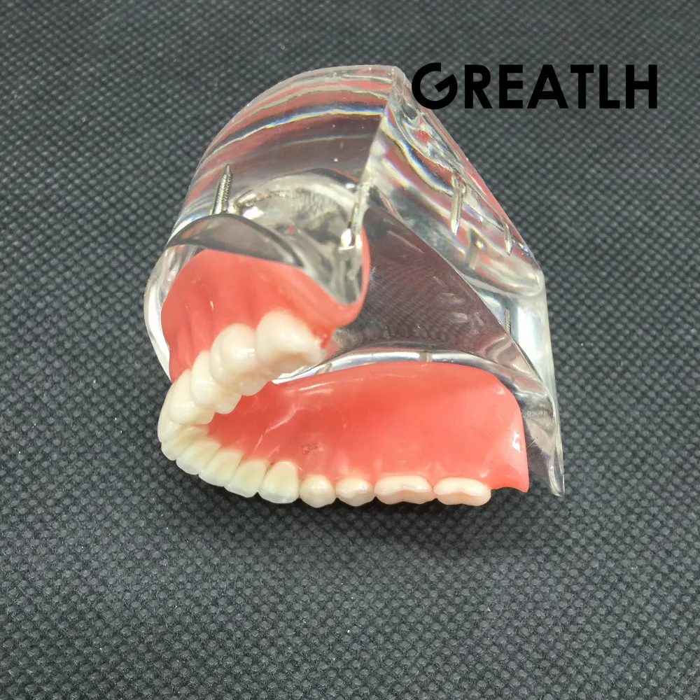 Nha Khoa Overdenture Nội Thất Mandibular Răng Hàm Dưới Mẫu Mandibular Với Giả Phục Hồi Răng Nha Khoa Giảng Dạy Học