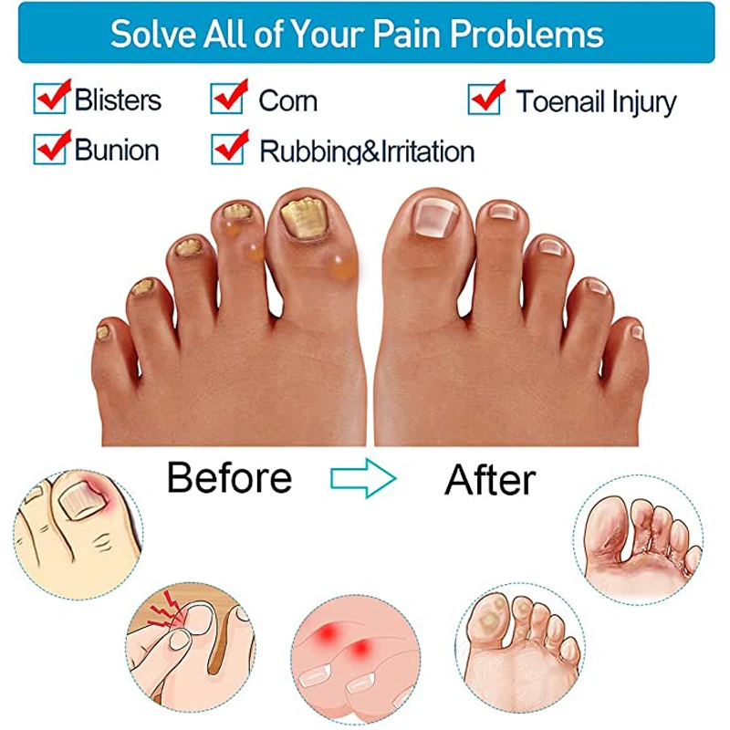 6pcs Silicone Toe Protectors Sleeve Prevent Blister Callus And Corn Relief Pain From Lngrown Toenails Foot Care Tool Toe Caps