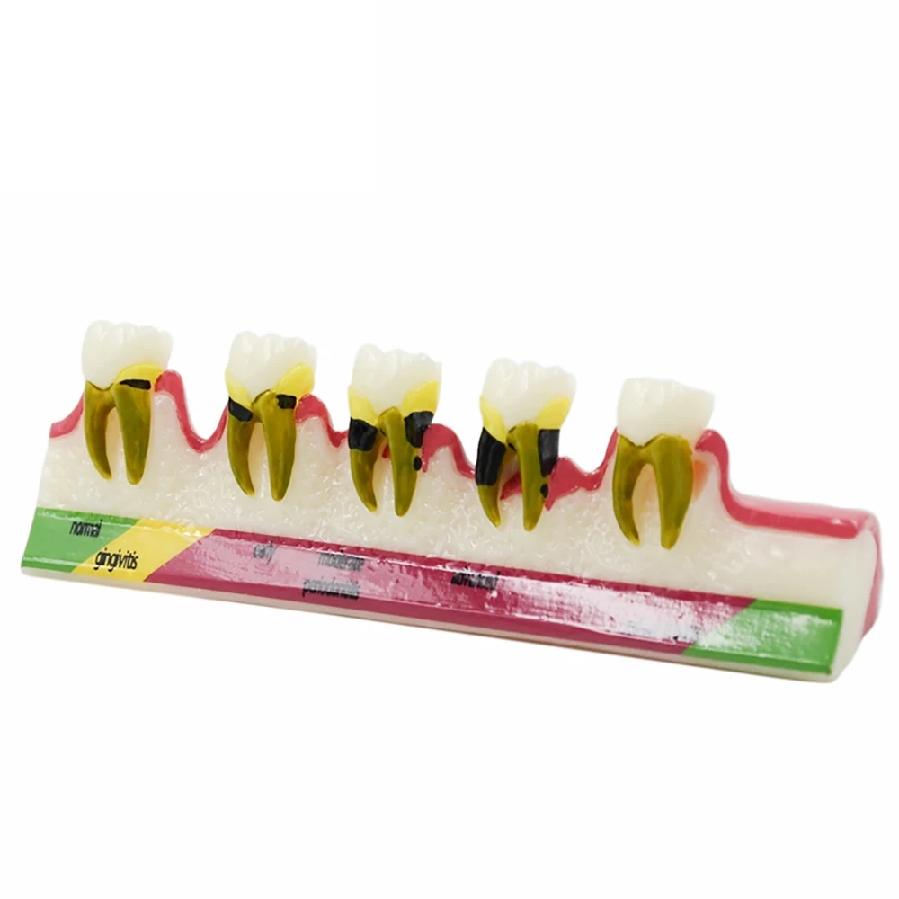 Dental Periodontal Disease assort Teeth Dentoform Typodont Study Teaching Model