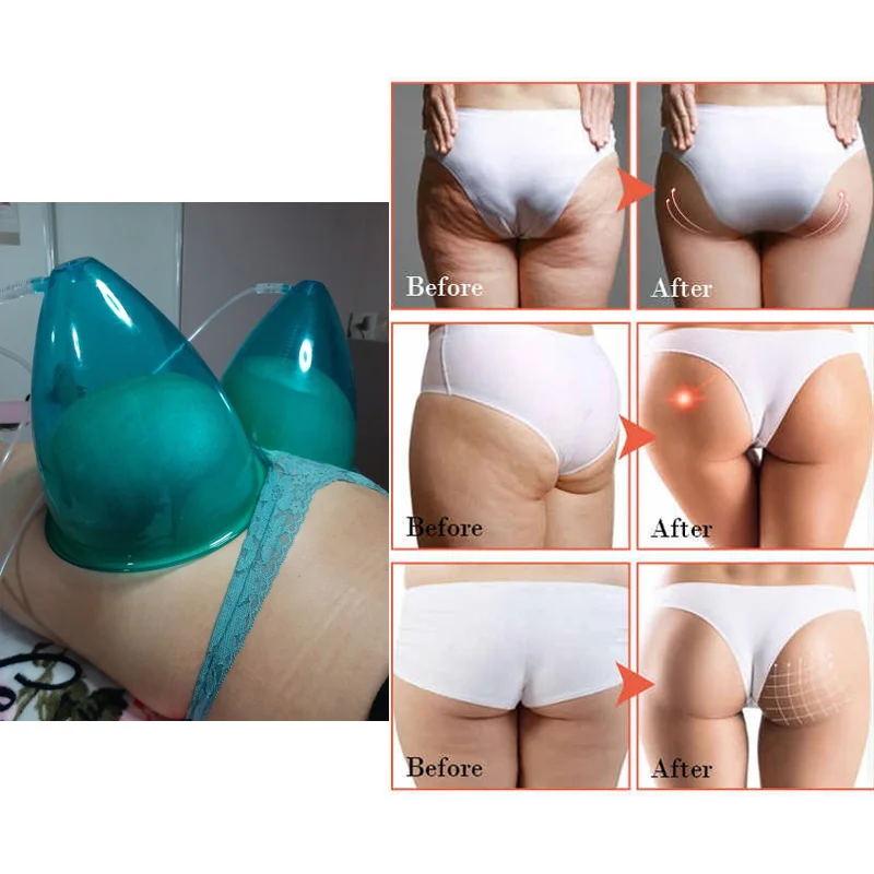 Vacuum Therapy System - Non-Invasive Breast Enhancement & Butt Lifting Device - Medical Grade Chest Massager and Gluteal