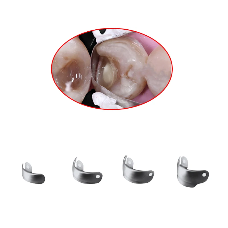 Bandas de matriz Dental seccionales contorneadas, matriz de Metal para reemplazo de dientes, herramientas de dentista, Material de odontología,