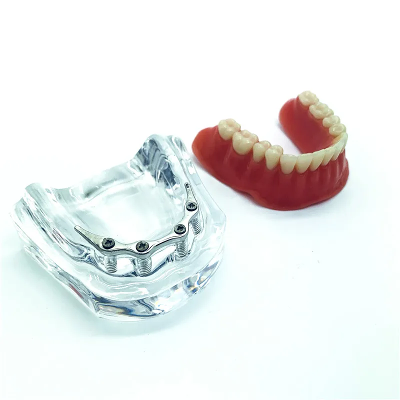 Modelo de implante mandibular para dentes, modelo para reparação de dentaduras e próteses dentárias