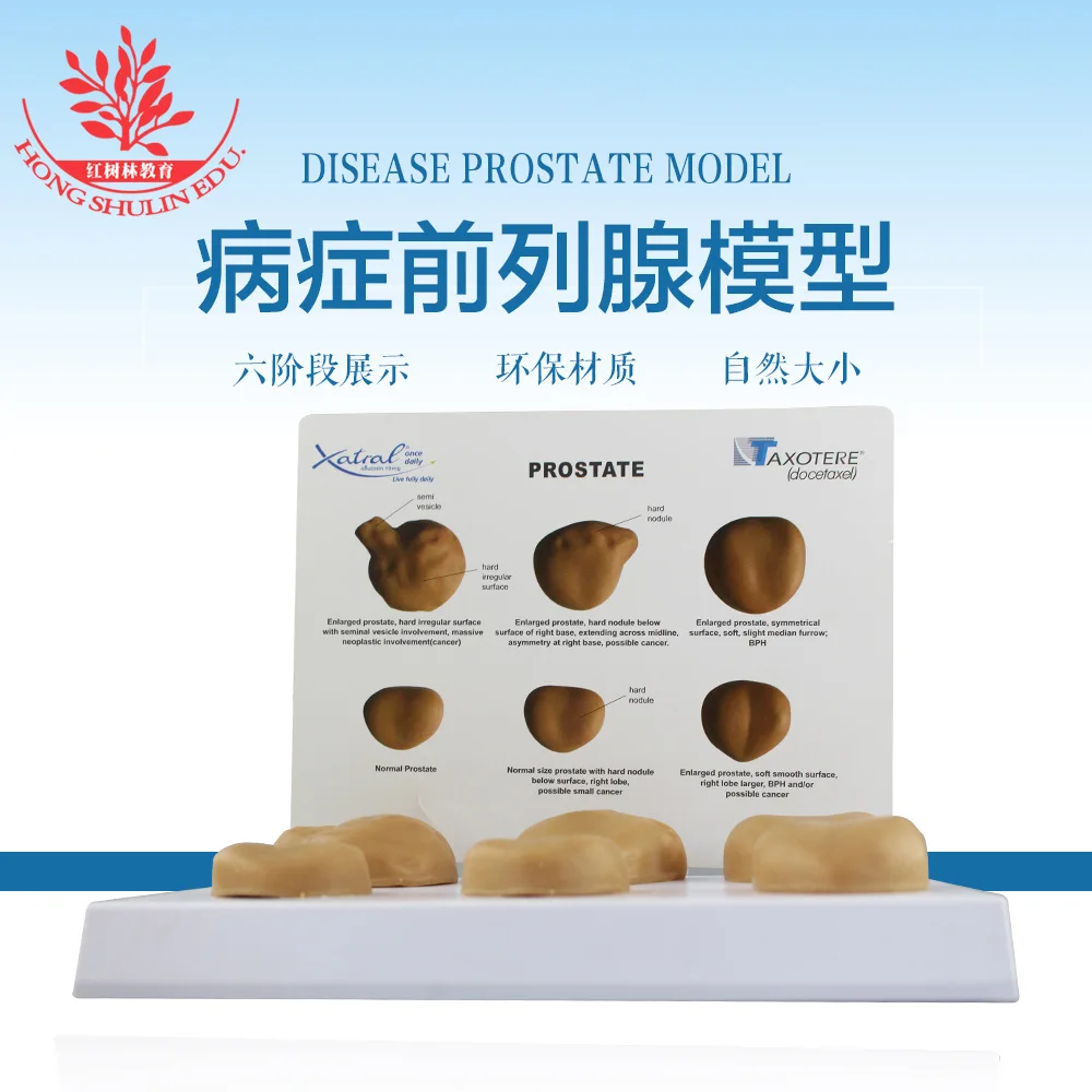 6pcs PVC Human Disease Pathological Prostate Simulation Model