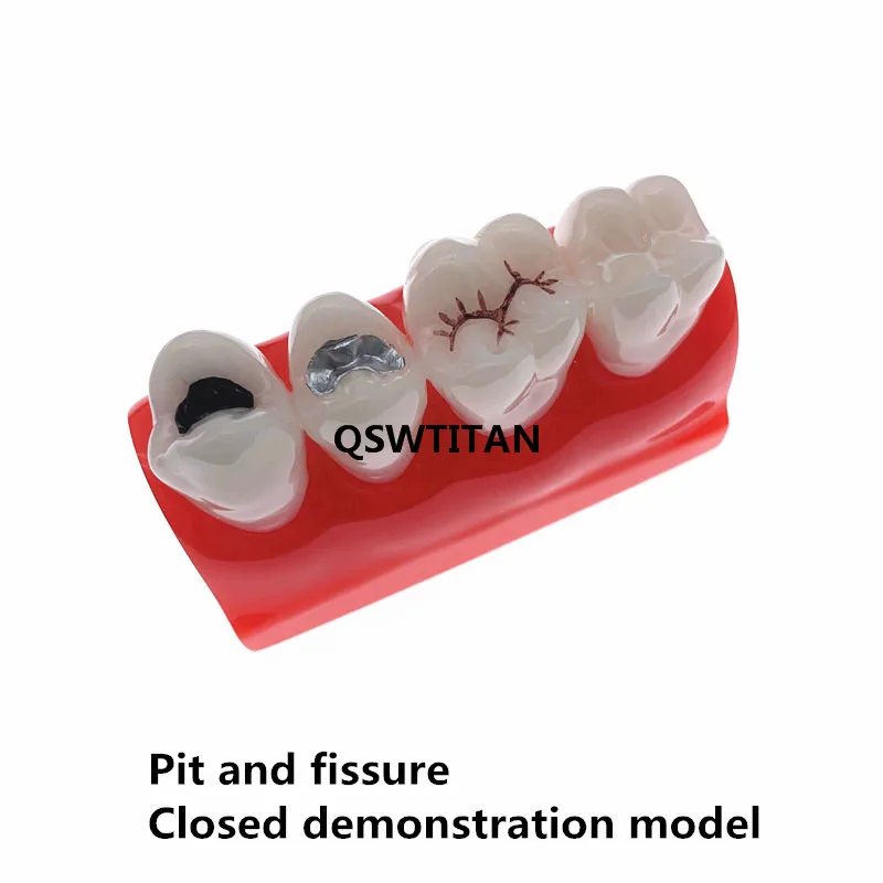 Badanie stomatologiczne dowiedzieć się Model dla Pit i szczeliny uszczelniania, model zębów