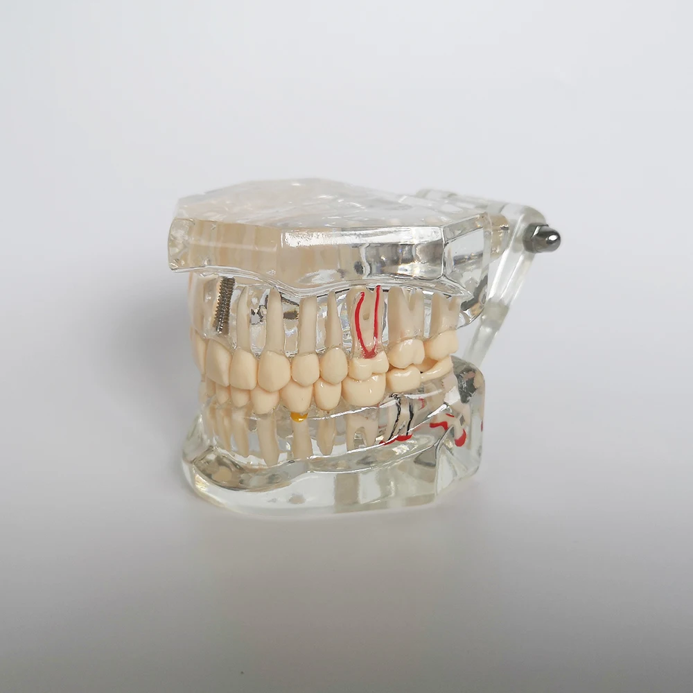 Neues Dentalmodell für Zahnimplantate, Restaurationsbrücken, Lehrmaterial für Medizinische Wissenschaft, Krankheiten, Zahnärzte und Zahnmedizinprodukte – Detail 6