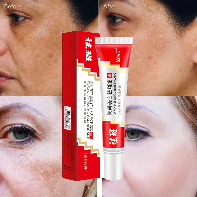 Whitening Freckle Cream Remove Dark Spots Anti Freckle Cream Fade Pigmentation Melasma Brighten Creams Skin Care 20g