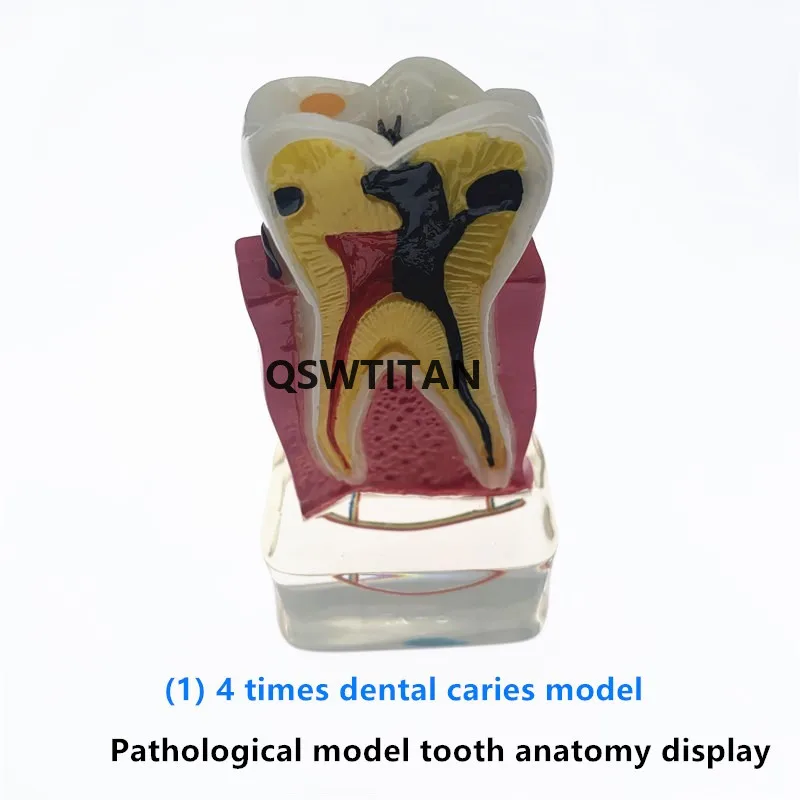 Model zębów 4 razy zębów patologii model kompleksowe przyzębia Model do nauczania badania modelu