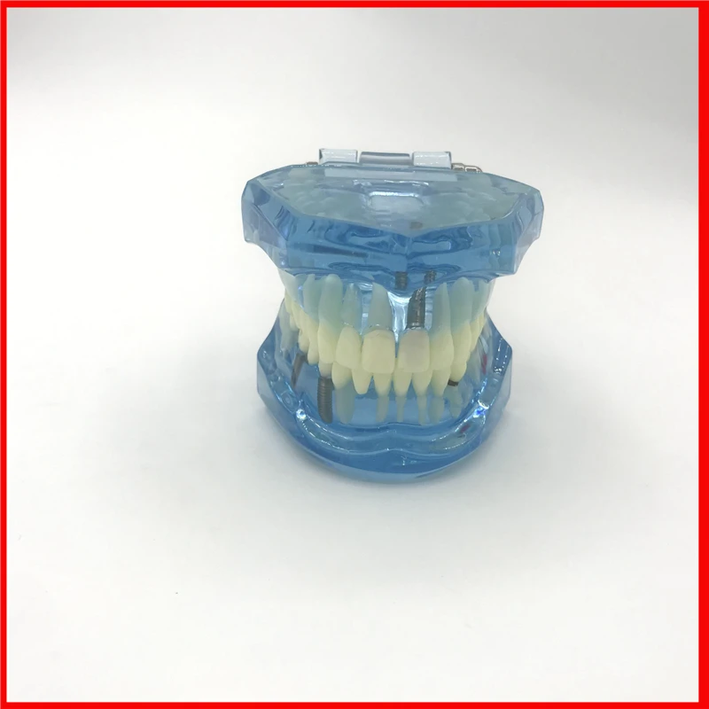 

Dental Study Tooth Model Adult Pathological teaching Teeth model new denshine