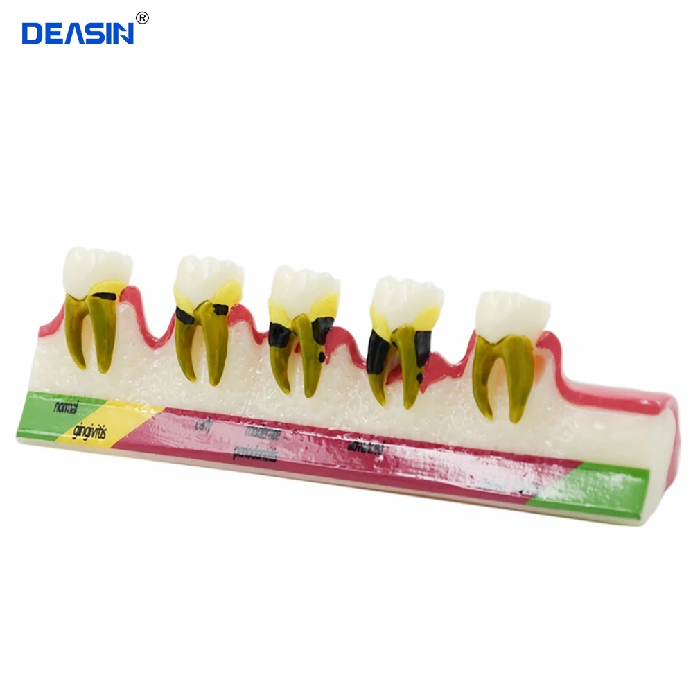 Dental Teeth Model Periodontal Disease Assort Tooth Classification Model